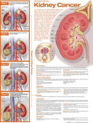 Understanding Kidney Cancer Anatomical Chart 2nd edition